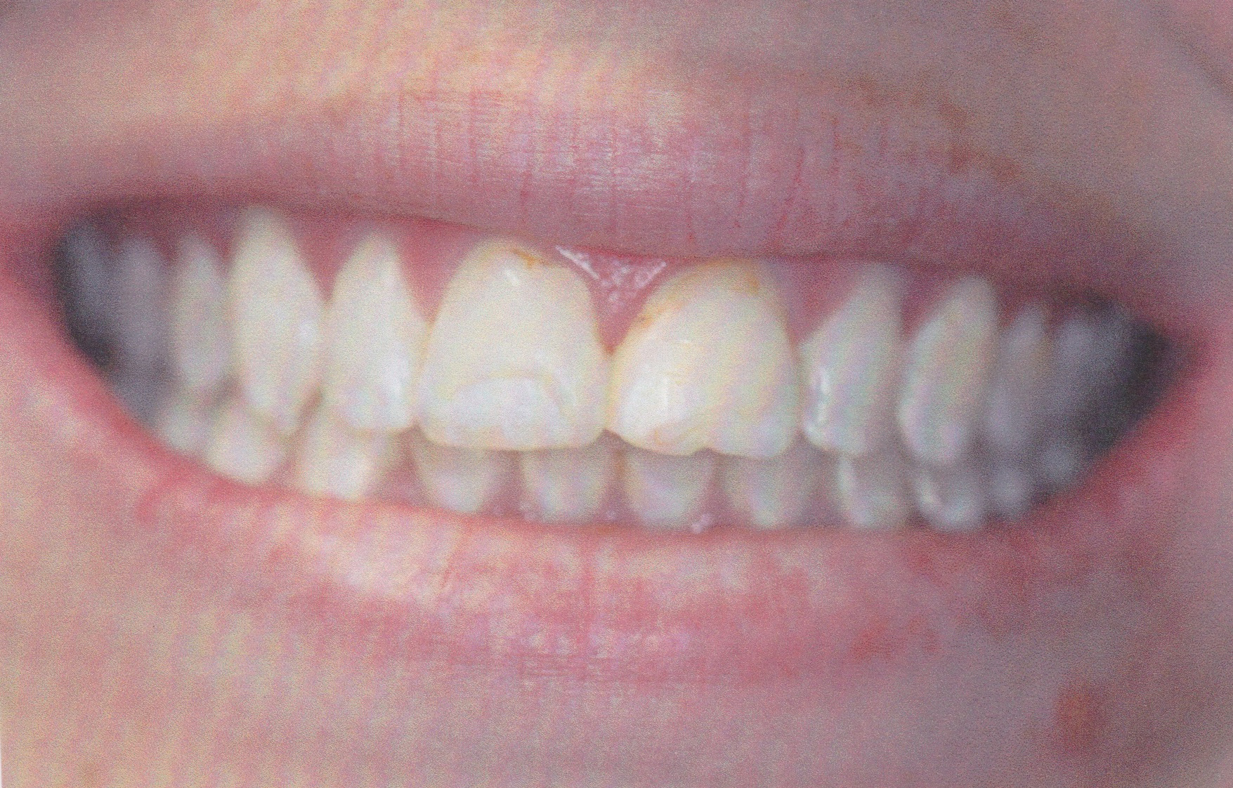 before treatment smile transformations