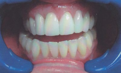 Porcelain veneers at beach dental