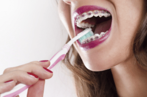 6 Cleaning Tips for Braces