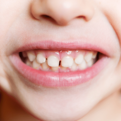 Closeup of a child's teeth, representing your child's teeth