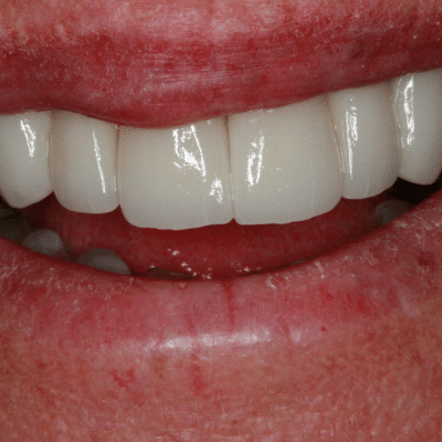 Beachdentalcenter the truth about plaque and tartar why regular professional teeth cleaning in virginia beach va matters blog